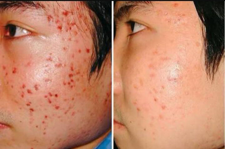 acne01